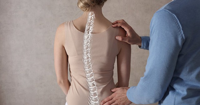 Thuốc điều trị vẹo cột sống- Ảnh 1. Thuốc điều trị vẹo cột sống- Ảnh 1.