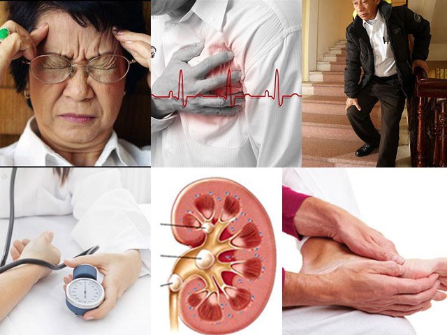 Câu hỏi thường gặp về bệnh xơ vữa động mạch não- Ảnh 1. Câu hỏi thường gặp về bệnh xơ vữa động mạch não- Ảnh 1.