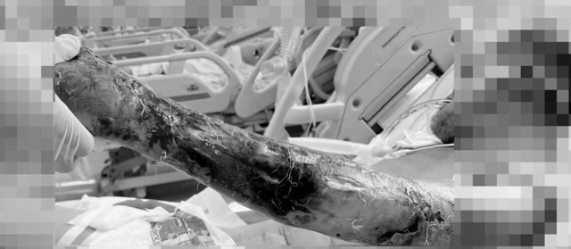 14 ngày căng thẳng giành giật sự sống cho bệnh nhân nhiễm vi khuẩn tụ cầu vàng- Ảnh 1. 14 ngày căng thẳng giành giật sự sống cho bệnh nhân nhiễm vi khuẩn tụ cầu vàng- Ảnh 1.