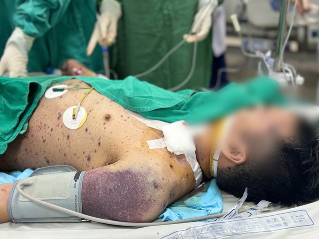 Hai thanh niên khỏe mạnh nguy kịch vì biến chứng thủy đậu- Ảnh 3. Hai thanh niên khỏe mạnh nguy kịch vì biến chứng thủy đậu- Ảnh 3.