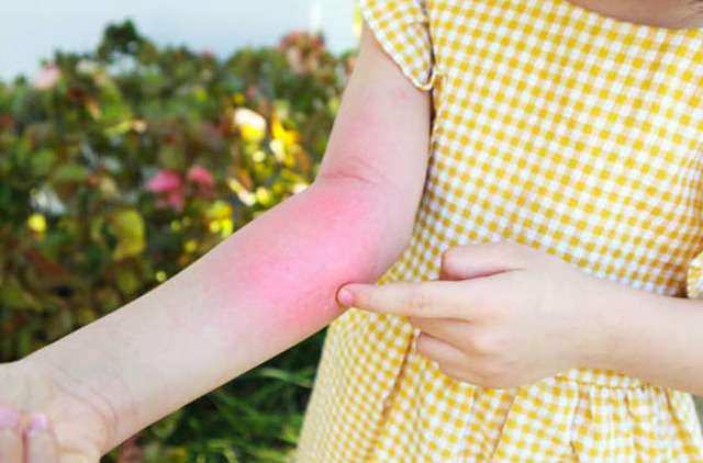 Dị ứng phấn hoa: Ai dễ mắc và cách phòng tránh hiệu quả- Ảnh 2. Dị ứng phấn hoa: Ai dễ mắc và cách phòng tránh hiệu quả- Ảnh 2.