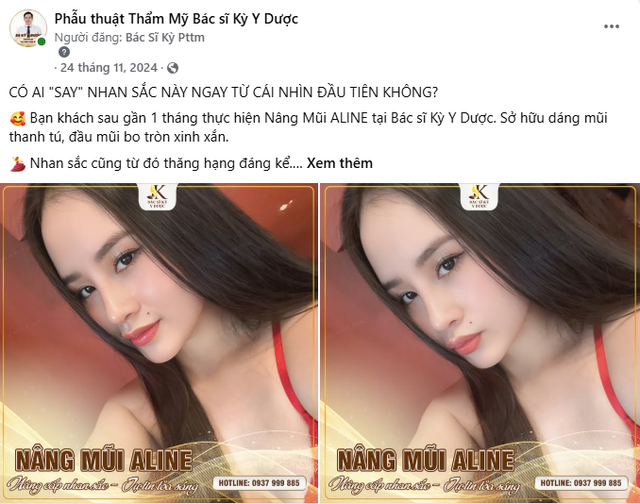 Tìm hiểu về nâng mũi Aline cùng Bác sĩ Kỳ Y Dược- Ảnh 3. Tìm hiểu về nâng mũi Aline cùng Bác sĩ Kỳ Y Dược- Ảnh 3.
