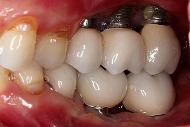 Nhiễm trùng Implant nguyên nhân do đâu? Dấu hiệu và cách khắc phục- Ảnh 2. Nhiễm trùng Implant nguyên nhân do đâu? Dấu hiệu và cách khắc phục- Ảnh 2.