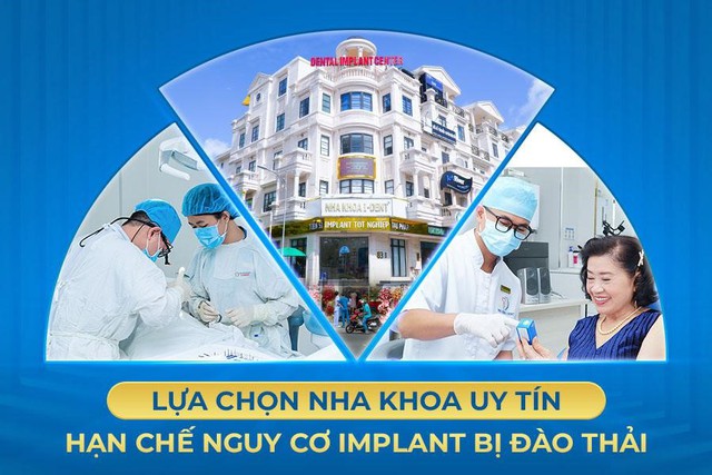 Implant bị đào thải do đâu? Cách khắc phục?- Ảnh 3. Implant bị đào thải do đâu? Cách khắc phục?- Ảnh 3.
