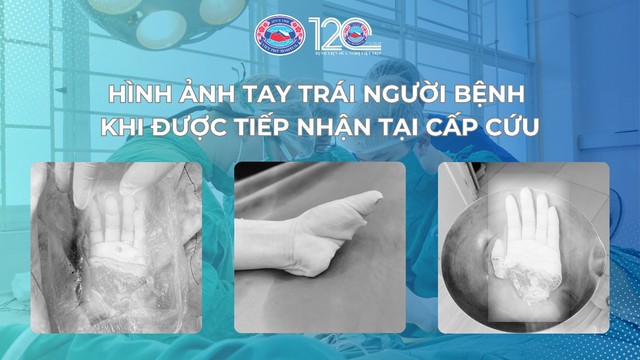 Bệnh viện Hữu nghị Việt Tiệp phẫu thuật tái nối thành công ca đứt rời nửa bàn tay trái, mở ra kỳ tích mới- Ảnh 1. Bệnh viện Hữu nghị Việt Tiệp phẫu thuật tái nối thành công ca đứt rời nửa bàn tay trái, mở ra kỳ tích mới- Ảnh 1.