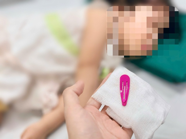 Thót tim gắp chiếc kẹp tóc sắc nhọn dài 5 cm trong dạ dày bé gái- Ảnh 4. Thót tim gắp chiếc kẹp tóc sắc nhọn dài 5 cm trong dạ dày bé gái- Ảnh 4.