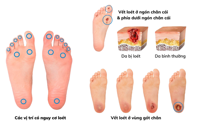 Tại sao đái tháo đường lại là ‘kẻ giết người thầm lặng’, có phòng ngừa được không?- Ảnh 2. Tại sao đái tháo đường lại là ‘kẻ giết người thầm lặng’, có phòng ngừa được không?- Ảnh 2.