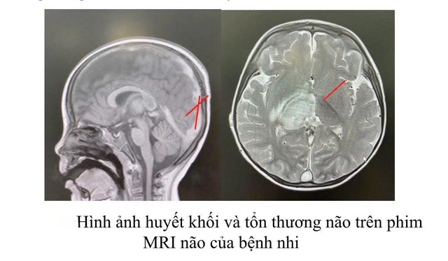 Cứu sống bé trai 2,5 tuổi bị huyết khối nội sọ do rối loạn chuyển hóa hiếm gặp- Ảnh 1.