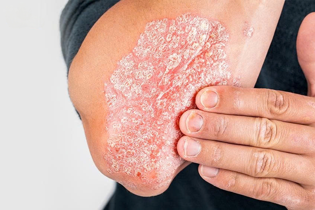 Kiểm soát vẩy nến lâu dài – Đừng chỉ lo xử lý triệu chứng mà quên mất gốc bệnh- Ảnh 1. Kiểm soát vẩy nến lâu dài – Đừng chỉ lo xử lý triệu chứng mà quên mất gốc bệnh- Ảnh 1.