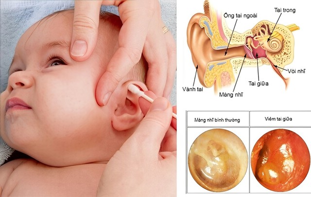 Trẻ dưới 2 tuổi bị viêm tai giữa cấp mủ: Cha mẹ cần làm gì để cải thiện nhanh triệu chứng?- Ảnh 1. Trẻ dưới 2 tuổi bị viêm tai giữa cấp mủ: Cha mẹ cần làm gì để cải thiện nhanh triệu chứng?- Ảnh 1.