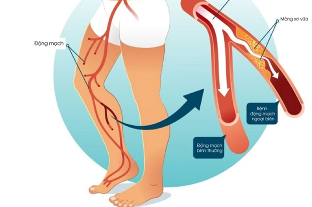 Câu hỏi thường gặp về bệnh xơ vữa động mạch ngoại biên- Ảnh 2.