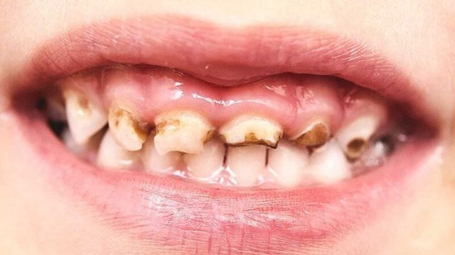 Chăm sóc răng miệng con trẻ: Những lưu ý quan trọng cha mẹ cần biết- Ảnh 1. Chăm sóc răng miệng con trẻ: Những lưu ý quan trọng cha mẹ cần biết- Ảnh 1.