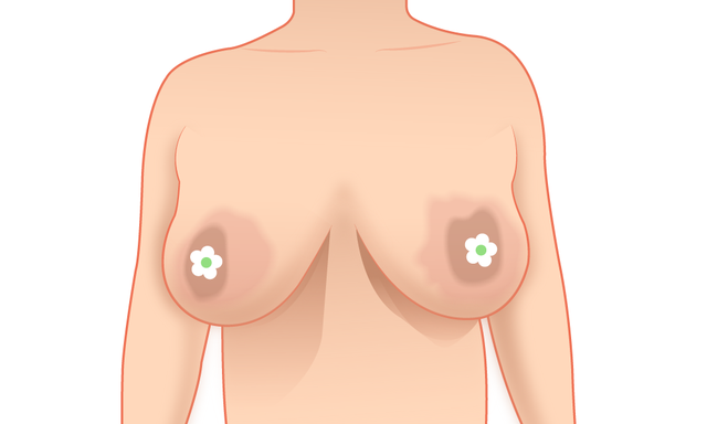 Biến chứng thẩm mỹ ngực sa trễ- Ảnh 1. Biến chứng thẩm mỹ ngực sa trễ- Ảnh 1.