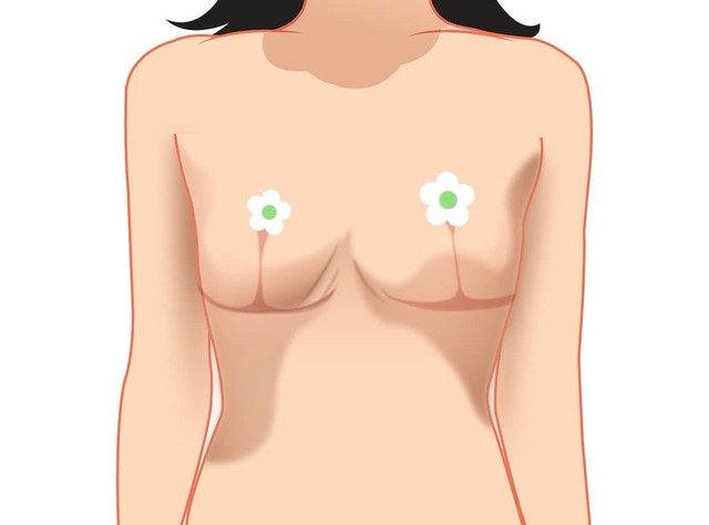 Biến chứng thẩm mỹ ngực sa trễ- Ảnh 3. Biến chứng thẩm mỹ ngực sa trễ- Ảnh 3.