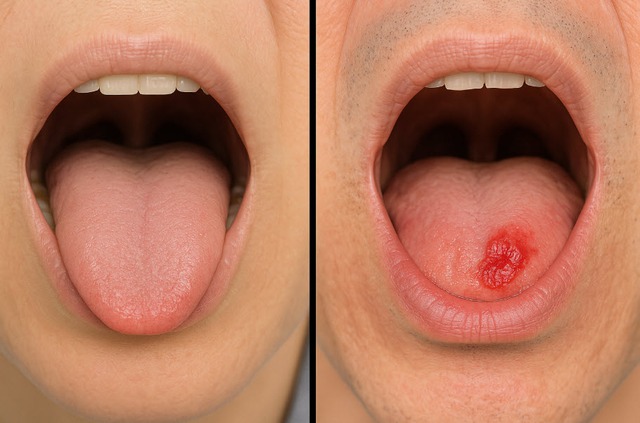8 nguy cơ gây ung thư miệng ít ai ngờ tới- Ảnh 2. 8 nguy cơ gây ung thư miệng ít ai ngờ tới- Ảnh 2.