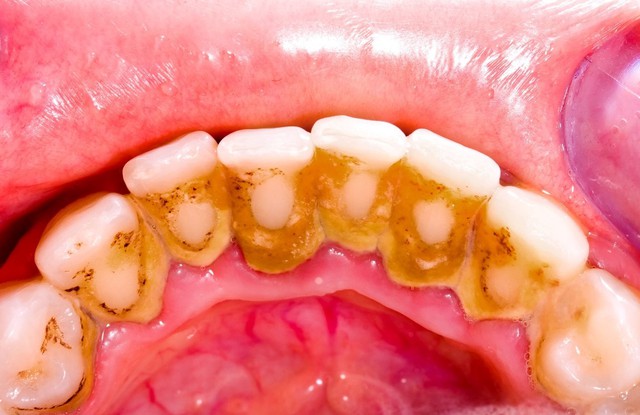 Ám ảnh tụt nướu: Dấu hiệu, nguyên nhân và 'lá chắn' bảo vệ nụ cười- Ảnh 2. Ám ảnh tụt nướu: Dấu hiệu, nguyên nhân và 'lá chắn' bảo vệ nụ cười- Ảnh 2.