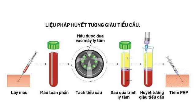 Tiêm huyết tương giàu tiểu cầu - Giải pháp cho người thoái hóa khớp gối?- Ảnh 1. Tiêm huyết tương giàu tiểu cầu - Giải pháp cho người thoái hóa khớp gối?- Ảnh 1.