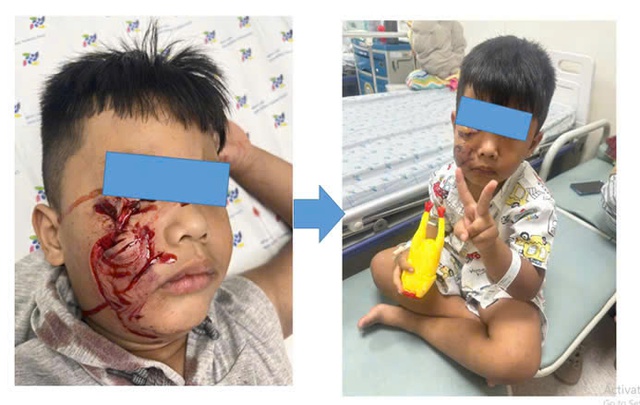Bé trai 5 tuổi bị chó cắn rách mặt phải khâu 20 mũi- Ảnh 1. Bé trai 5 tuổi bị chó cắn rách mặt phải khâu 20 mũi- Ảnh 1.