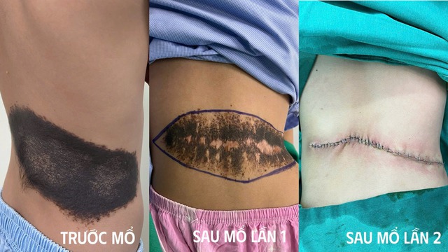 Phẫu thuật thành công khối u sắc tố khổng lồ ở lưng bé 8 tuổi- Ảnh 3.