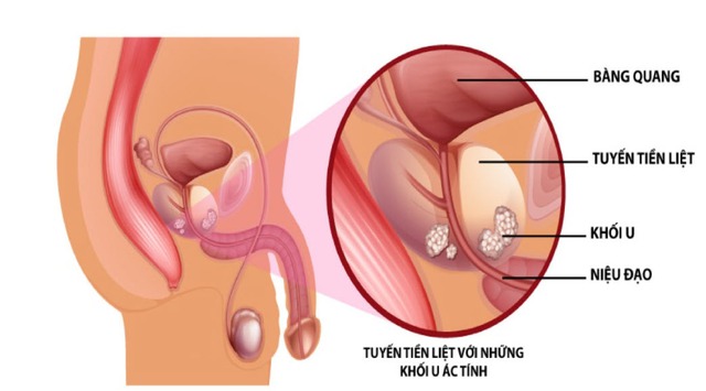 Ung thư tiền liệt tuyến có thể chữa khỏi nếu phát hiện sớm và điều trị kịp thời- Ảnh 2.