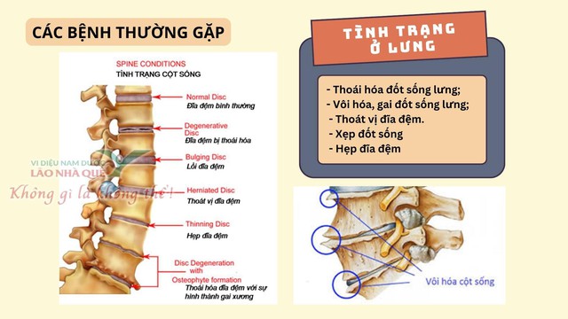 Phương pháp 'Khai thông cột sống' điều trị đau do thoái hóa khớp tại Lão Nhà Quê- Ảnh 1.