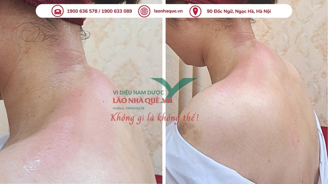 Đau vai gáy dai dẳng - cảnh báo thoái hóa đốt sống cổ từ thói quen xấu- Ảnh 2. Đau vai gáy dai dẳng - cảnh báo thoái hóa đốt sống cổ từ thói quen xấu- Ảnh 2.