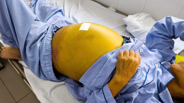 Da vàng như nghệ, mắc xơ gan vì tự ý bỏ thuốc điều trị viêm gan B - Ảnh 2.