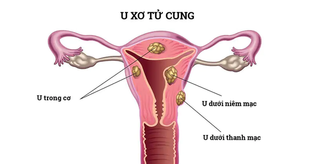 U xơ tử cung dưới niêm mạc là gì và ảnh hưởng sức khỏe thế nào?- Ảnh 1.