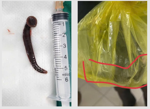 Bị đỉa chui vào niệu đạo khi đang làm đồng, người đàn ông có một hành động bất ngờ- Ảnh 1.