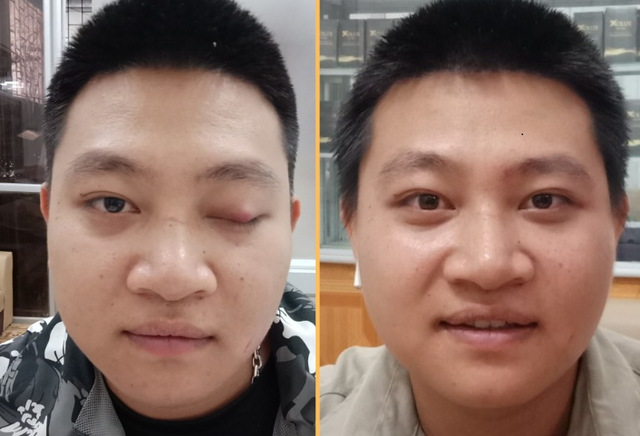 Phương pháp Đông y trong điều trị sụp mí mắt do liệt dây thần kinh số 3- Ảnh 3. Phương pháp Đông y trong điều trị sụp mí mắt do liệt dây thần kinh số 3- Ảnh 3.