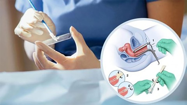 Cách tốt nhất để phát hiện sớm ung thư cổ tử cung- Ảnh 1.