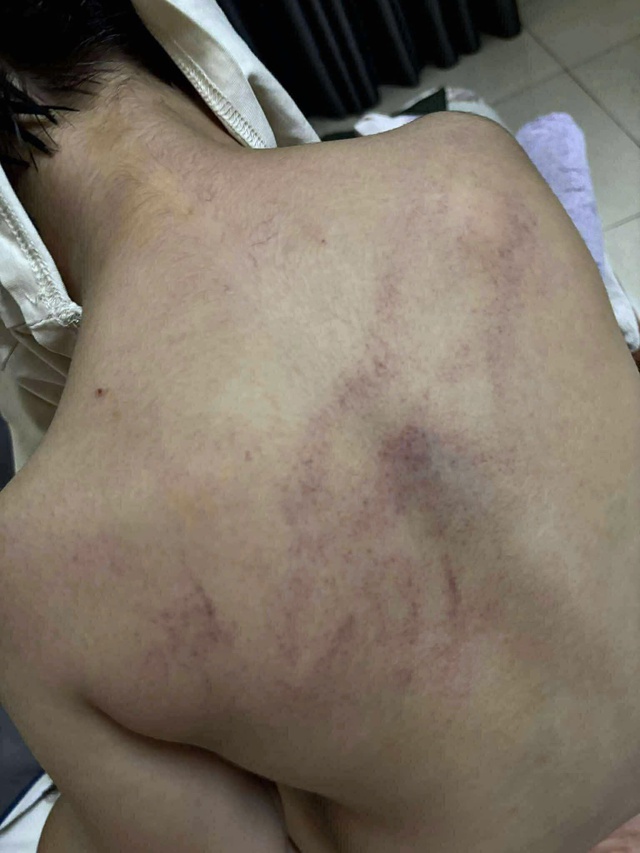 Bé gái mầm non nghi bị bạo hành, đánh tím lưng tại Hà Nội- Ảnh 2. Bé gái mầm non nghi bị bạo hành, đánh tím lưng tại Hà Nội- Ảnh 2.