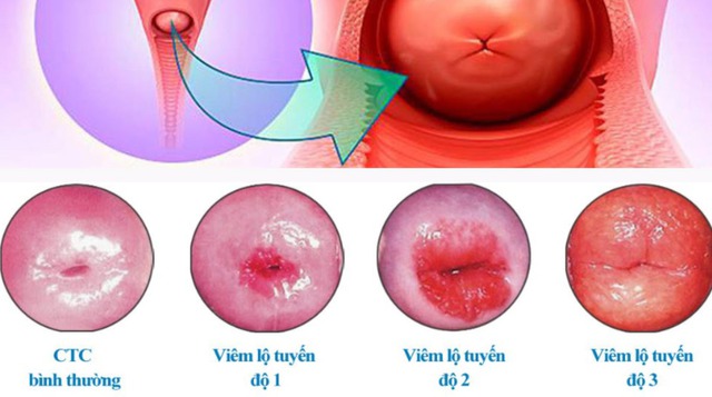 Cảnh báo biến chứng nguy hiểm của viêm lộ tuyến cổ tử cung- Ảnh 2. Cảnh báo biến chứng nguy hiểm của viêm lộ tuyến cổ tử cung- Ảnh 2.