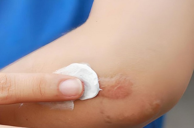 Lâm Đồng: Đình chỉ lưu hành, thu hồi 'gel ngừa sẹo' vi phạm 3 lỗi- Ảnh 1.