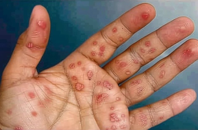 Xét nghiệm chẩn đoán và điều trị bệnh giang mai- Ảnh 1.