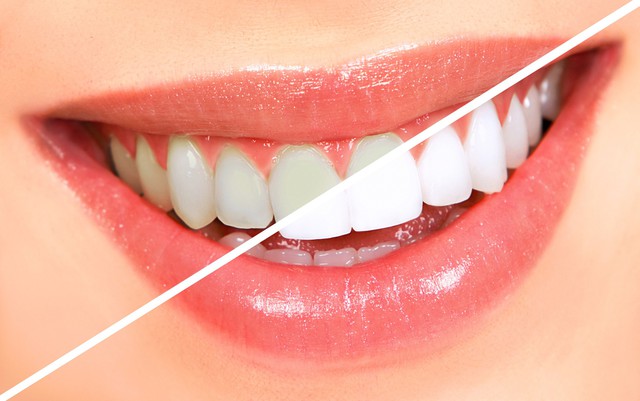 Tẩy trắng răng có hại không?- Ảnh 1. Tẩy trắng răng có hại không?- Ảnh 1.