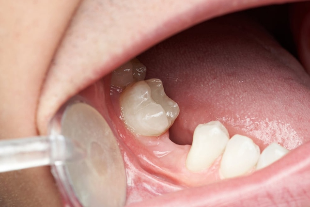 Mất răng số 7 hàm dưới có sao không? Giải pháp khắc phục hiệu quả- Ảnh 1. Mất răng số 7 hàm dưới có sao không? Giải pháp khắc phục hiệu quả- Ảnh 1.