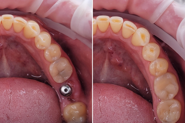 Mất răng số 7 hàm dưới có sao không? Giải pháp khắc phục hiệu quả- Ảnh 2. Mất răng số 7 hàm dưới có sao không? Giải pháp khắc phục hiệu quả- Ảnh 2.