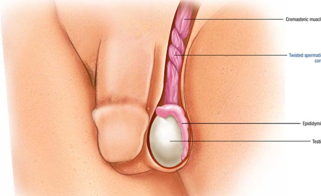 Cách xử lý xoắn tinh hoàn để không mất khả năng sinh sản- Ảnh 1. Cách xử lý xoắn tinh hoàn để không mất khả năng sinh sản- Ảnh 1.