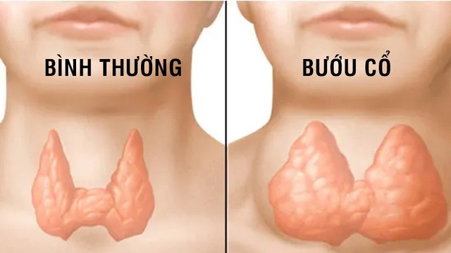 Thiếu i-ốt gây hại như thế nào?- Ảnh 1.