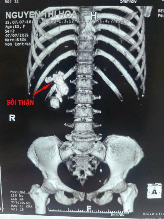 Phẫu thuật thành công ca sỏi thận san hô phức tạp - Ảnh 1. Phẫu thuật thành công ca sỏi thận san hô phức tạp - Ảnh 1.