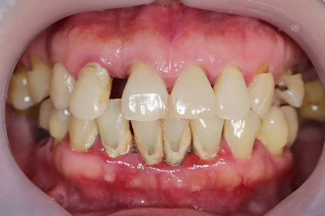 Viêm nha chu ở người cao tuổi: 'Rào cản' chất lượng cuộc sống- Ảnh 1.