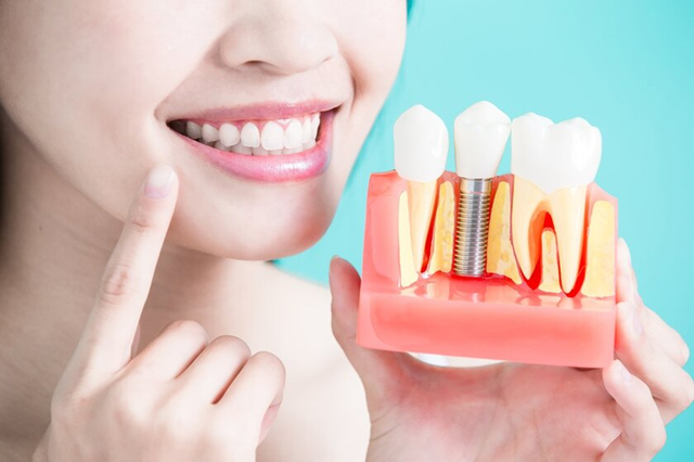 Chăm sóc nướu sau implant: Bảo vệ răng từ gốc- Ảnh 1.