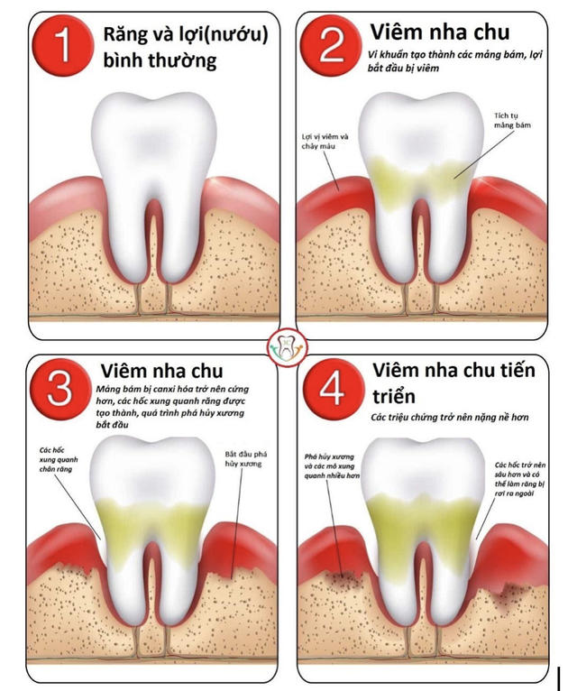 Bệnh nha chu – Làm thế nào để phòng ngừa và điều trị?- Ảnh 2. Bệnh nha chu – Làm thế nào để phòng ngừa và điều trị?- Ảnh 2.