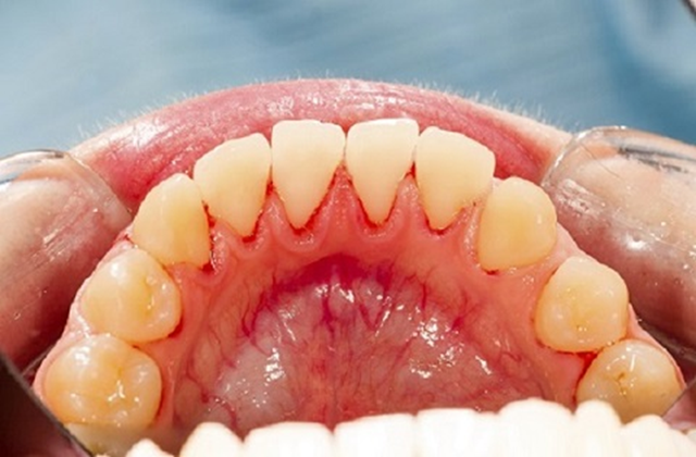 Chảy máu chân răng – Cơ thể cảnh báo điều gì?- Ảnh 2. Chảy máu chân răng – Cơ thể cảnh báo điều gì?- Ảnh 2.
