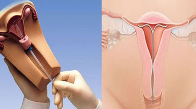 Tránh thai nội tiết có thực sự tốt cho phụ nữ?- Ảnh 1.