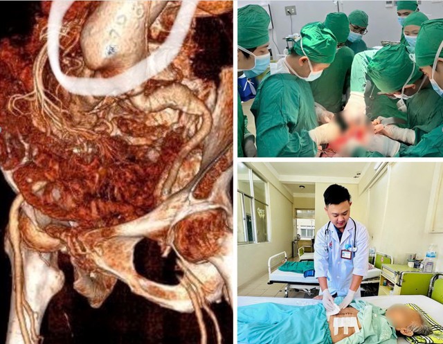Phẫu thuật cứu sống kịp thời bệnh nhân 86 tuổi vỡ phình động mạch chủ bụng- Ảnh 2. Phẫu thuật cứu sống kịp thời bệnh nhân 86 tuổi vỡ phình động mạch chủ bụng- Ảnh 2.