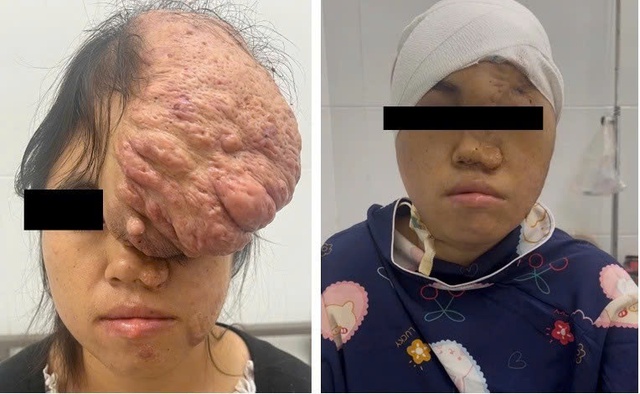 'Giải cứu' cô gái Mông mang khối u khổng lồ 25 × 35 cm vùng đỉnh trán- Ảnh 1. 'Giải cứu' cô gái Mông mang khối u khổng lồ 25 × 35 cm vùng đỉnh trán- Ảnh 1.