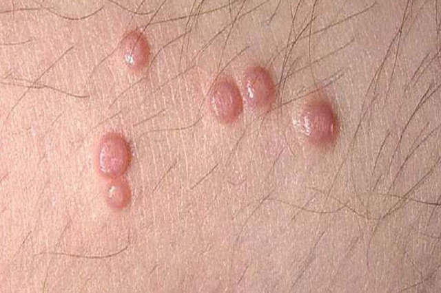 5 bệnh có thể lây qua quan hệ tình dục không an toàn, đầu tiên là HIV- Ảnh 2. 5 bệnh có thể lây qua quan hệ tình dục không an toàn, đầu tiên là HIV- Ảnh 2.