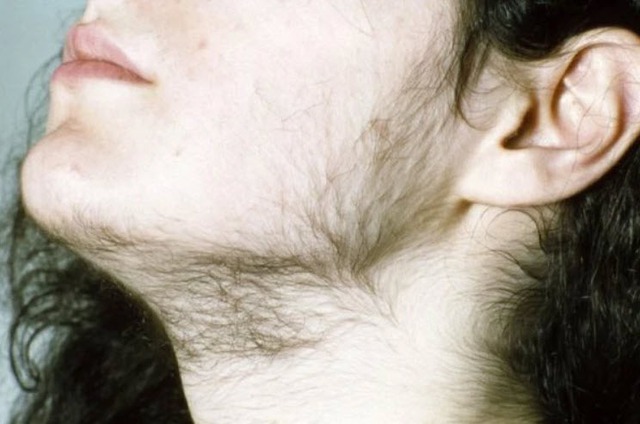 Cường androgen ở phụ nữ có biểu hiện gì?- Ảnh 2.
